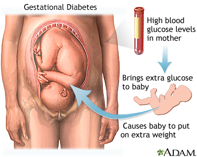 women who experience gestational diabetes