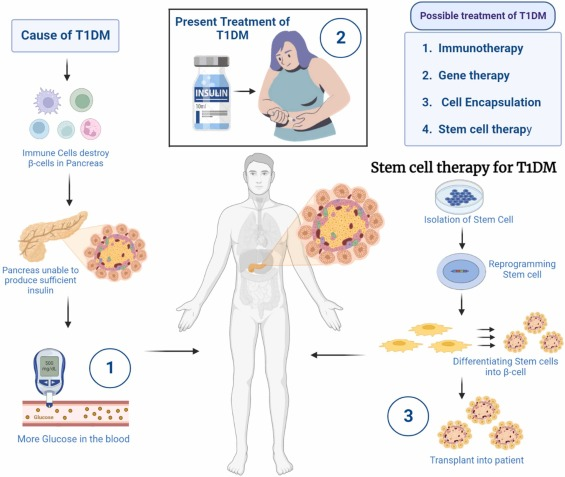 Type 1 Diabetes Experimental Treatment: Exploring the Future of Diabetes Management